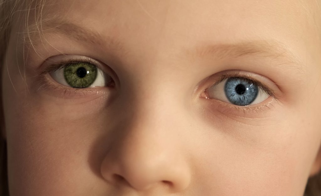 child-with-heterochromia